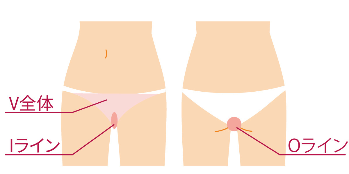 女性VIO脱毛部位