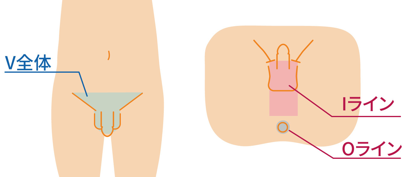 男性VIO脱毛部位